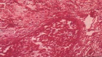 Fotomicrografía de Vasos Pulmonares con trombos micóticos Coloración de PAS 40x.