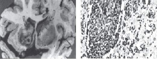 Paciente con sida y linfoma primario con toxoplasmosis Paciente con sida y linfoma primario con toxoplasmosis