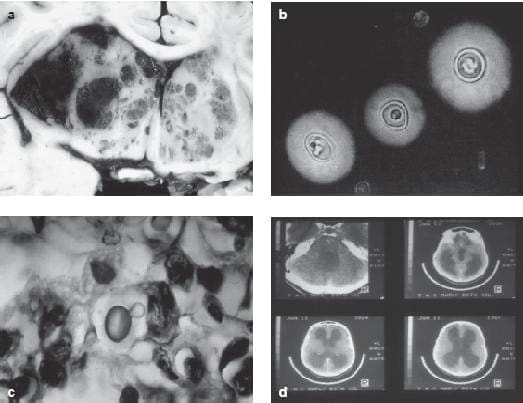 Criptocosis cerebral Criptocosis cerebral