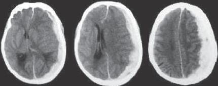 TAC Craneo con hematoma subdural