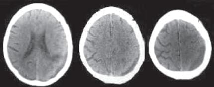 TAC de craneo con absorcion progresiva TAC de craneo con absorcion progresiva
