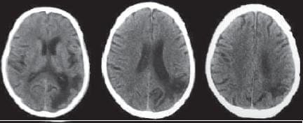 TAC de craneo simple sin hematoma TAC de craneo simple sin hematoma