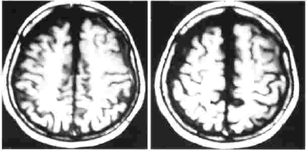Resonancia magnética cerebral Resonancia magnética cerebral