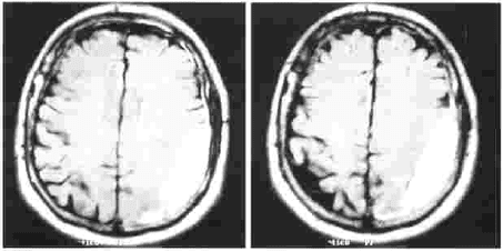 Resonancia magnética cerebral inicial Resonancia magnética cerebral inicial