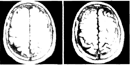 Resonancia magnética cerebral Resonancia magnética cerebral