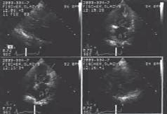 Vista de cuatro cavidades