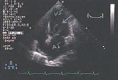 Vista del ventriculo izquierdo