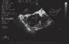 Aórta ascendente en el plano