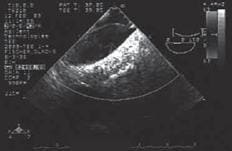 Imagen de la aorta ascendente