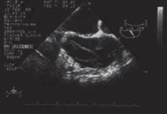 Imagen del ventrículo izquierdo