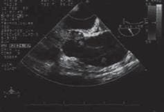 Imagen del ventriculo izquierdo