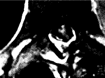 Imagen coronal de resonancia magnetica