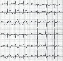 Cambios infarto de grado posterior comparación III
