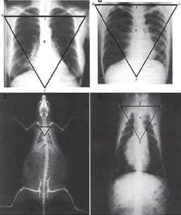 Triángulo equilátero de einthoven