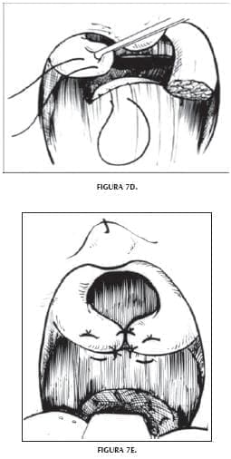 Esfínter muscular dinámico Esfínter muscular dinámico