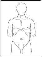 Distribución de los Trocares con Víad de Acceso Suprapúbico Distribución de los Trocares con Víad de Acceso Suprapúbico