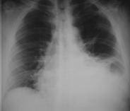 Radiografía de Tórax. Ángulo Costofrénico Izquierdo Obliterado  Radiografía de Tórax. Ángulo Costofrénico Izquierdo Obliterado