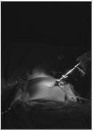 Introducción Inicial del Laparoscopio con Ángulo de 30° por T1 Introducción Inicial del Laparoscopio con Ángulo de 30° por T1