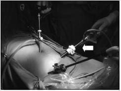 Obsérvese el Cambio de Posición del Laparoscopio de T1 a T2 Obsérvese el Cambio de Posición del Laparoscopio de T1 a T2