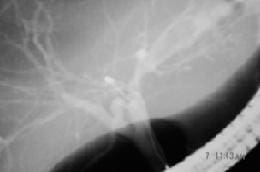 Colangiografía Retrógrada Endoscópica que Muestra la Dilatación Colangiografía Retrógrada Endoscópica que Muestra la Dilatación