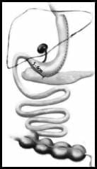 Representación esquemática del surset gástrico de Sales Representación esquemática del surset gástrico de Sales