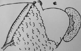 Cobertura del Área Expuesta del Parénquima Hepático Cobertura del Área Expuesta del Parénquima Hepático