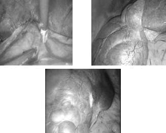 Quiste Adherido al Diafragma, Quiste del Lóbulo Derecho y Quiste del Lóbulo Izquierdo