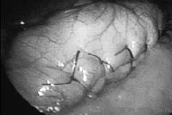 Surset Gástrico de Sales; Se Observa la Plicatura  Surset Gástrico de Sales; Se Observa la Plicatura