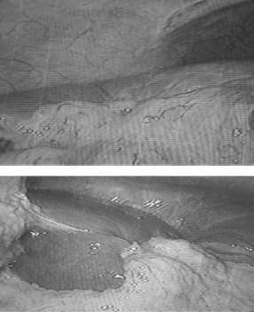 Migración de Epiplón al Lecho de los Quistes