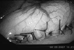 Surset Gástrico de Sales, Plicatura Completa Surset Gástrico de Sales, Plicatura Completa