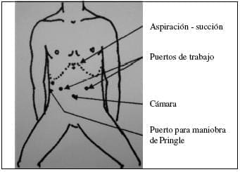 Posición del Paciente en Cirugía y colocación de los Puertos Laparoscópicos Posición del Paciente en Cirugía y colocación de los Puertos Laparoscópicos