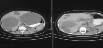 Resección del Techo del Quiste (Derecha), con Imagen de Quiste Central 