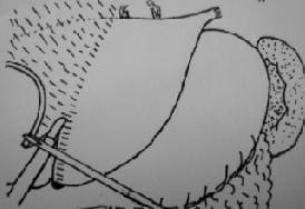 Disección del Ligamento Falciforme y posteriormente del Ligamento Triangular Izquierdo Disección del Ligamento Falciforme y posteriormente del Ligamento Triangular Izquierdo