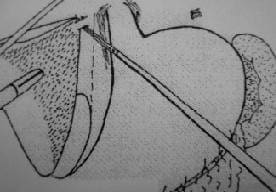 Finalización Liberación Área Ciega del Hígado Finalización Liberación Área Ciega del Hígado