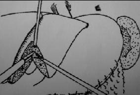 Hepatectomía Anterior un Centímetro Lateral al Ligamento Faciforme Hepatectomía Anterior un Centímetro Lateral al Ligamento Faciforme