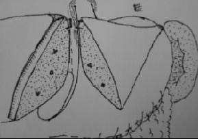 Finalización de la Segmentectomía Lateral Izquierda Finalización de la Segmentectomía Lateral Izquierda