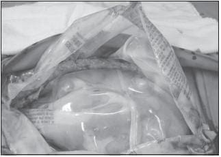 Utilización de Doble Bolsa Plástica en la Técnica del Abdomen Abierto