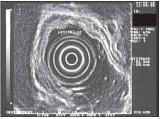 Tumor ha Invadido la Capa Muscular Propia, Estadio T2