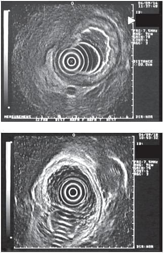 Engrosamiento y la Destrucción de las Capas Ecográficas Característicos de una Linitis Plástica