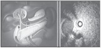 La Ecoendoscopia es Útil para Detectar Microlitiasis