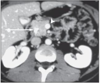 Masa Ubicada en la Cabeza del Páncreas y Vasos están Respetados por la Lesión