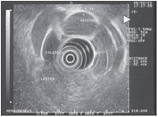 Imagen se Observa una Masa Heterogénea Ubicada en la Cabeza del Páncreas