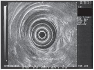   Paciente con Pancreatitis Crónica