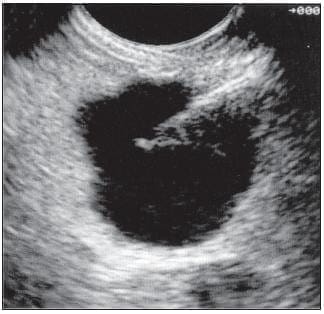 Quiste en el Cuerpo Páncreas que está Siendo Puncionado para Estudio del Líquido Quiste en el Cuerpo Páncreas que está Siendo Puncionado para Estudio del Líquido