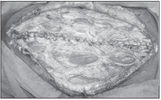 Cierre de la Pared Abdominal