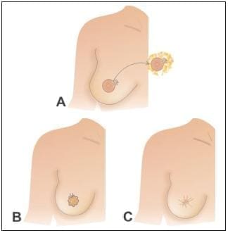 Resección del Tumor que Incluye el Complejo Areola-Pezón