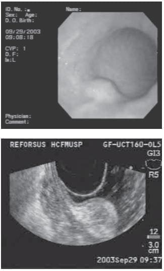 Lesión Subepitelial Gástrica y Lesión Hiperecoica
