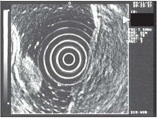 Lesión Hipoecoica que Sólo Compromete la Primera Ecocapa o Mucosa Superficial