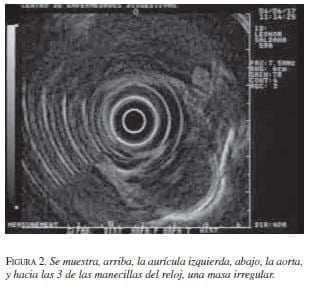 Aurícula Izquierda y la Aorta