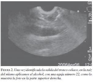 Salida del Tronco Celiaco Salida del Tronco Celiaco